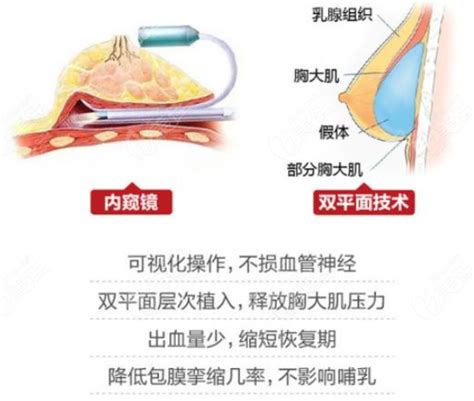 隆胸物料